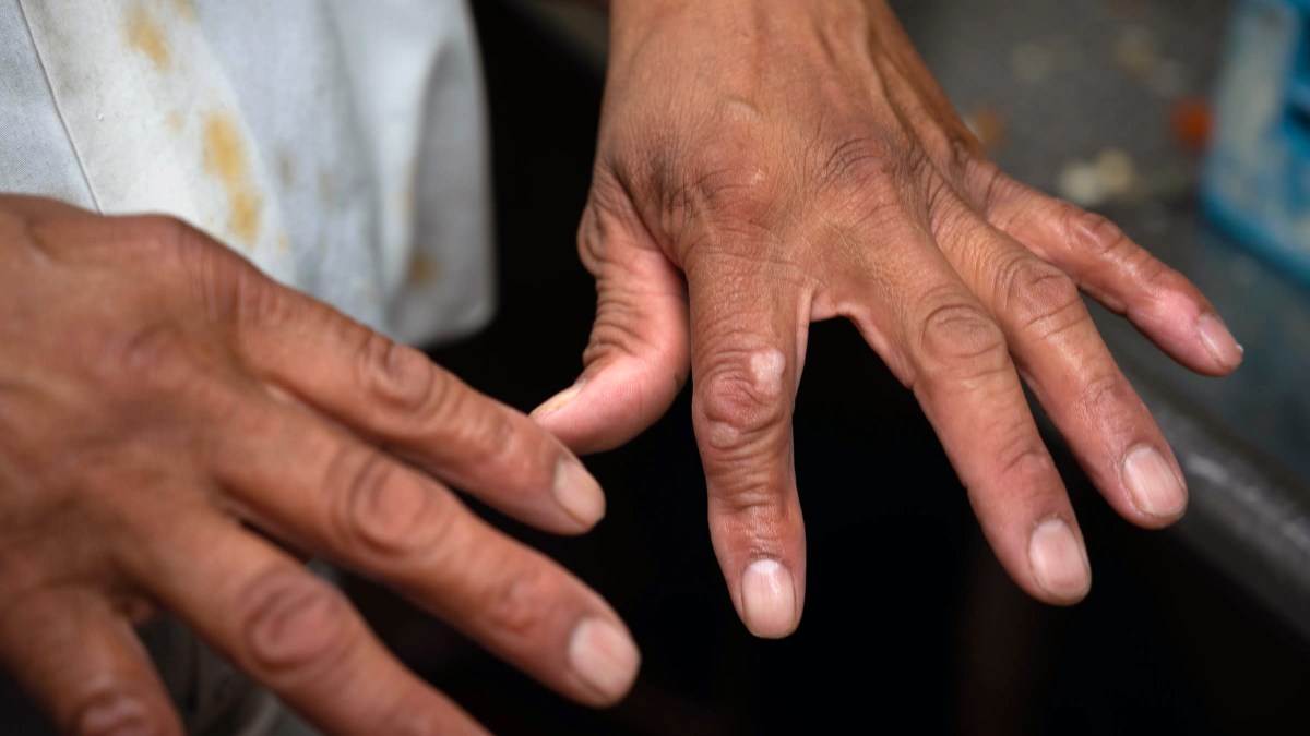 Shortly after being evicted from his home, Miguel was hit by a drunk driver while biking. He still has the scars on his hands from the accident.